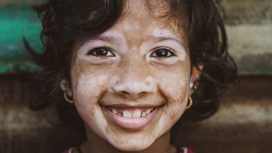 Casting niños de 5 a 13 años con vitiligo para proyecto de moda en España