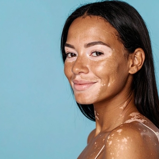 Casting hombres y mujeres de 18 a 30 años con vitiligo para spot publicitario